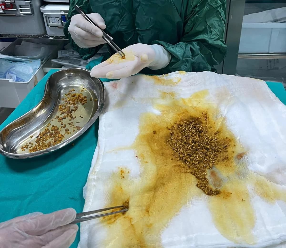 Bingöl’de Ameliyatla Safra Kesesinden 2 Bin 67 Taş Çıkarıldı